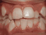 crowding of the teeth before treatment