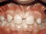 missing lateral incisors before treatment