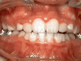 Phase 1 after treatment