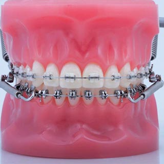 thumb-ortho-appliance-02-forsus
