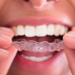 Aligner Style Retainers, or Essix Retainers