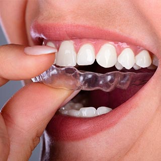 Clear Aligners in Lafayette