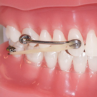 HERBST® Ortho Appliance