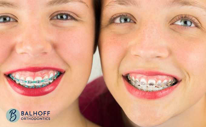 Teeth whitening is not impossible during your orthodontic treatment, but you should first consider if it's best to do so before or after your treatment.