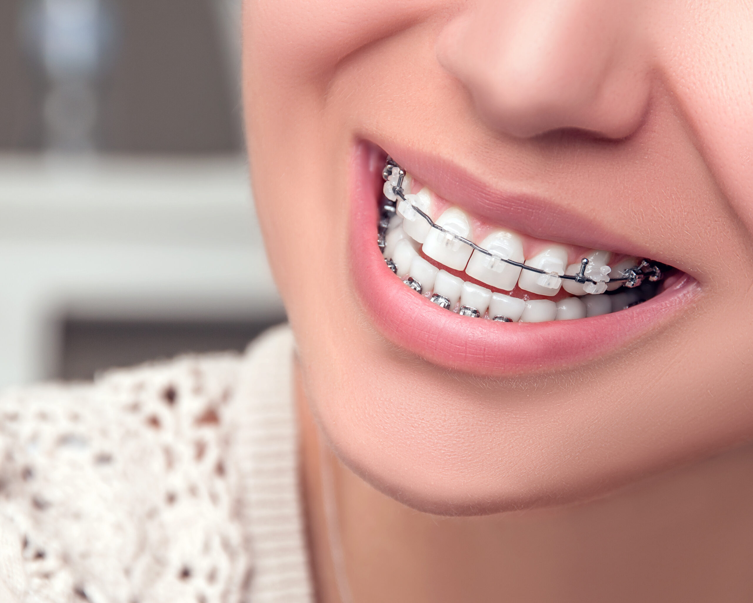 clear-braces